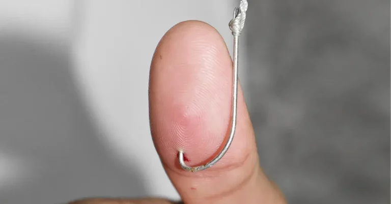 0 featured 2022 07 how to remove a fish hook from hands